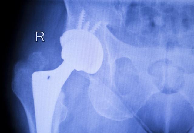 Veštački kuk traje 20 godina